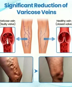 VascuCare Vein Healing Spray