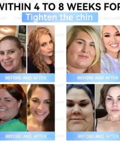 𝐒limming & 𝐻ealth 𝑁ano 𝑀icroneedle 𝑃atch