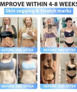 𝐒limming & 𝐻ealth 𝑁ano 𝑀icroneedle 𝑃atch