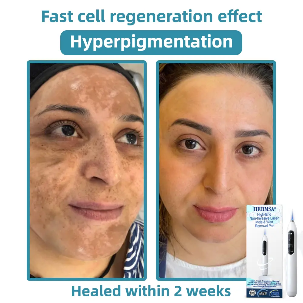 High-End Non-Invasive Laser Mole & Wart Removal Pen - Image 10