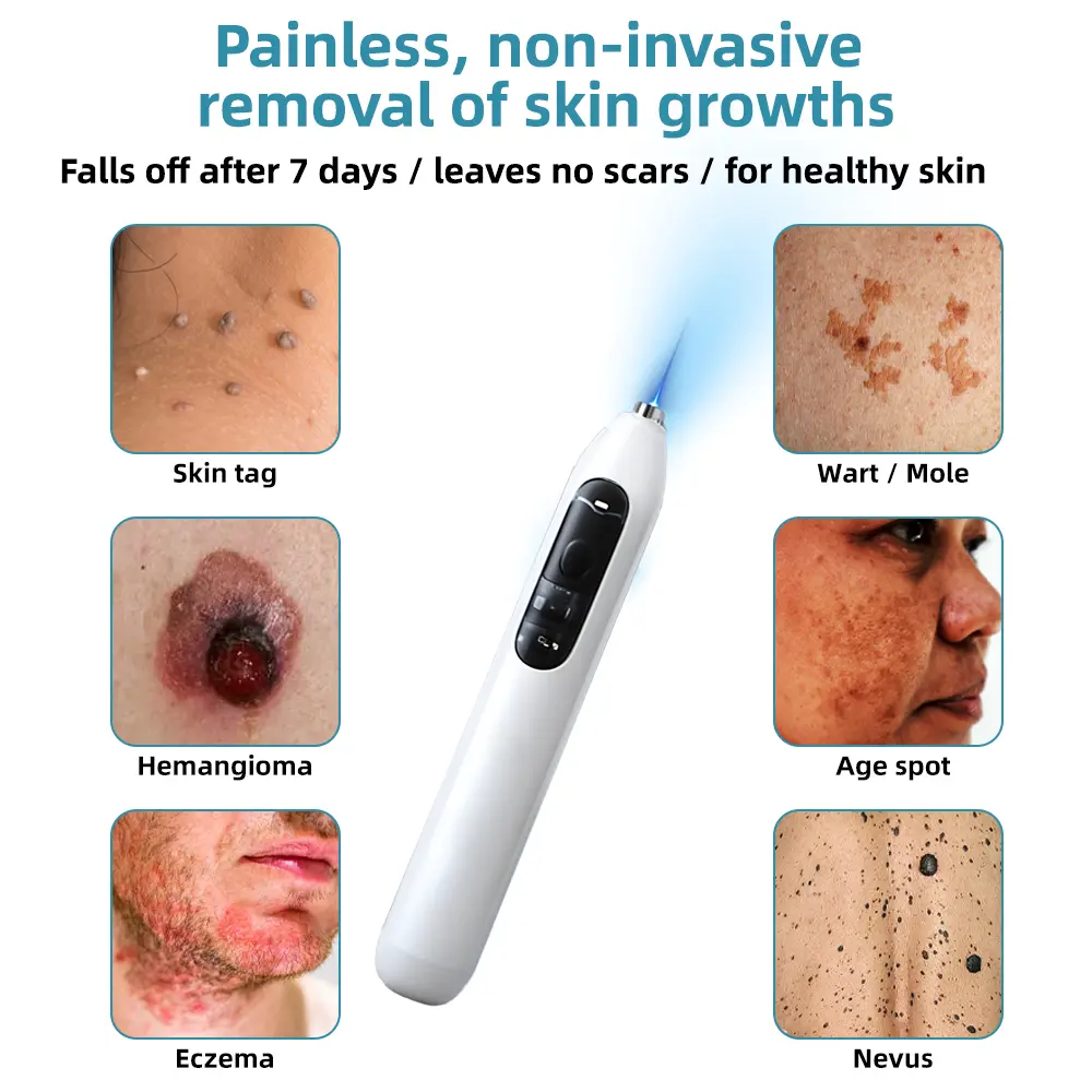High-End Non-Invasive Laser Mole & Wart Removal Pen - Image 2