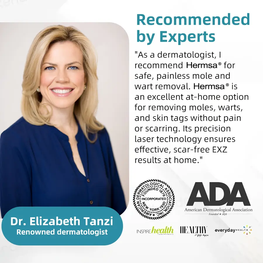 High-End Non-Invasive Laser Mole & Wart Removal Pen - Image 4