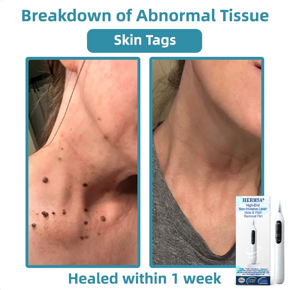 High-End Non-Invasive Laser Mole & Wart Removal Pen - Image 5