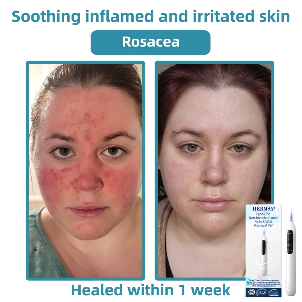 High-End Non-Invasive Laser Mole & Wart Removal Pen - Image 7