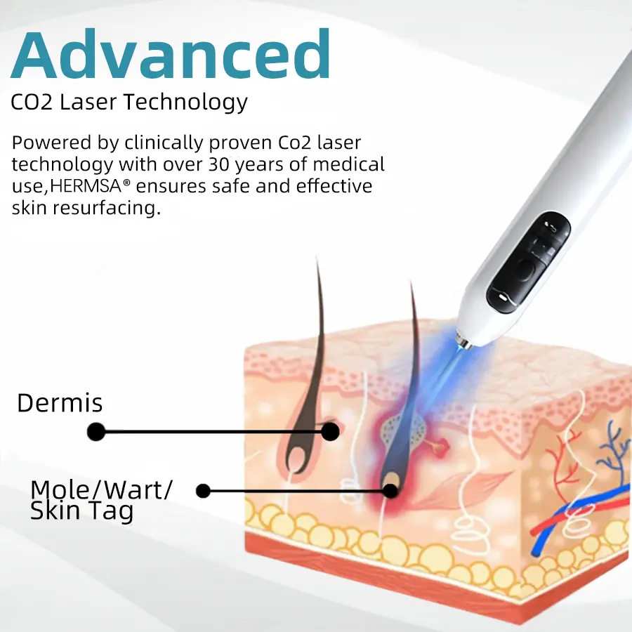 High-End Non-Invasive Laser Mole & Wart Removal Pen - Image 8