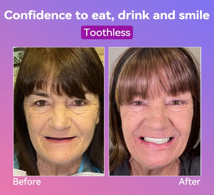 Latest Premium Comfort Dentures - Image 3