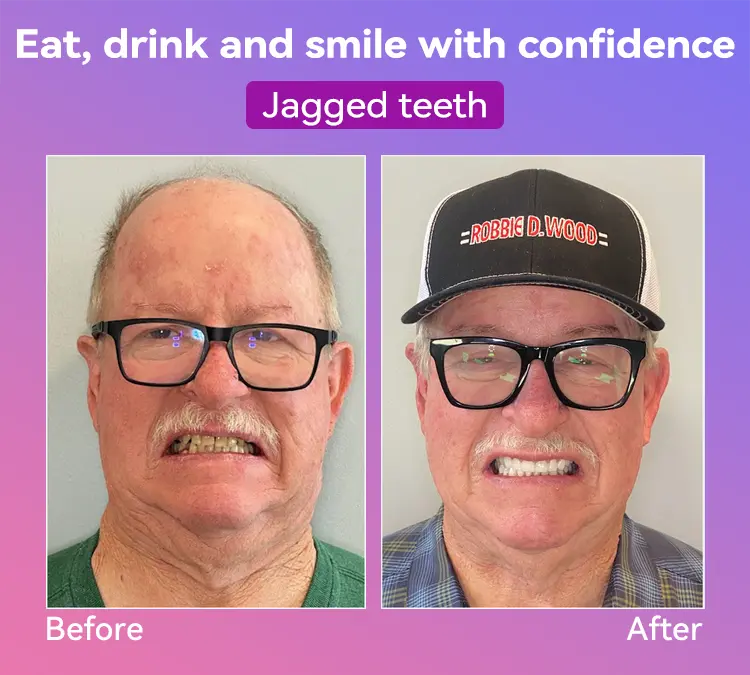 Latest Premium Comfort Dentures - Image 5