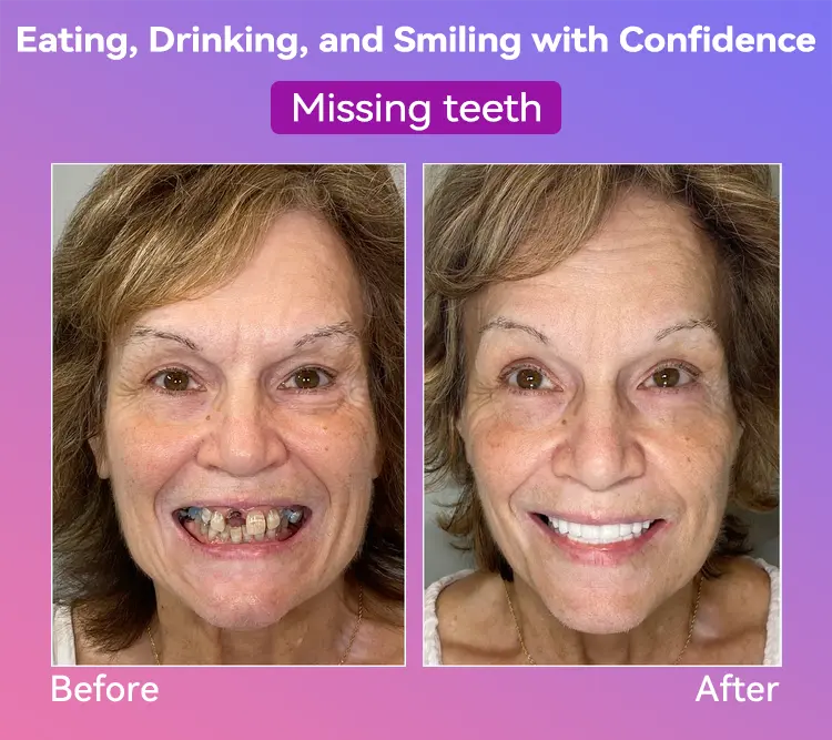 Latest Premium Comfort Dentures - Image 6