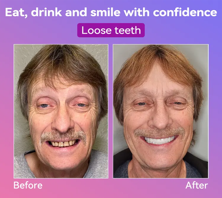 Latest Premium Comfort Dentures - Image 7