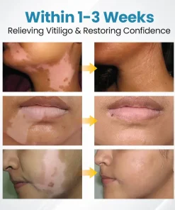 Bikenda® DermaBeam Vitiligo Therapy Device