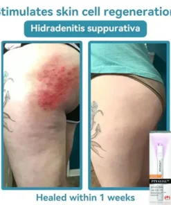 Ptyalial™ All-in-One CO₂ Laser Eraser Pen