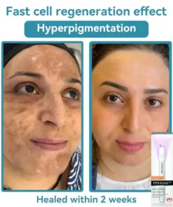 Ptyalial™ All-in-One CO₂ Laser Eraser Pen