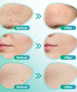 𝗖𝗮𝗿𝗲𝗕𝗿𝗲𝗲𝘇𝗲® 3-in-1 Microneedle Care Patch