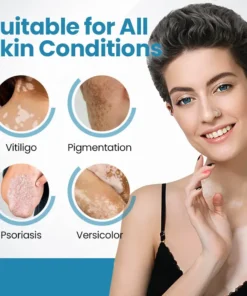 Acezozla® DermaBeam Vitiligo Therapy Device