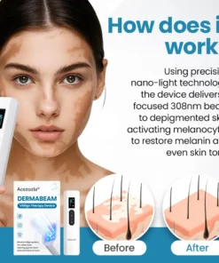 Acezozla® DermaBeam Vitiligo Therapy Device