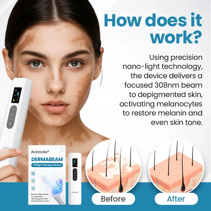 Acezozla® DermaBeam Vitiligo Therapy Device