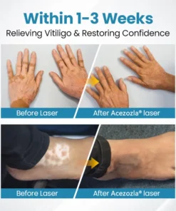 Acezozla® DermaBeam Vitiligo Therapy Device