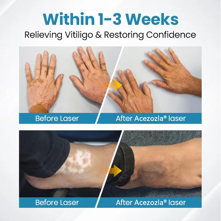 Acezozla® DermaBeam Vitiligo Therapy Device
