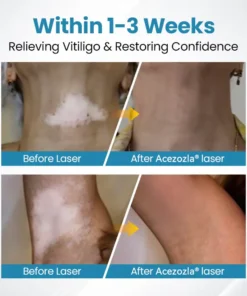 Acezozla® DermaBeam Vitiligo Therapy Device