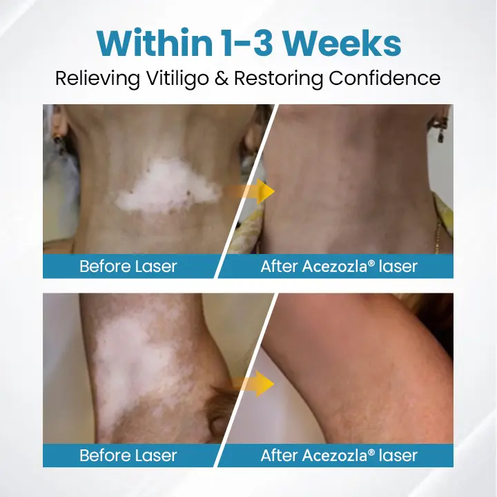 Acezozla® DermaBeam Vitiligo Therapy Device