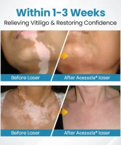Acezozla® DermaBeam Vitiligo Therapy Device