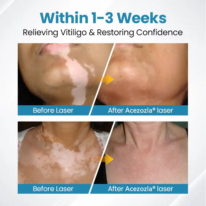 Acezozla® DermaBeam Vitiligo Therapy Device