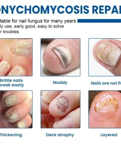 Acezozla® Fungus Nail Repair Patches