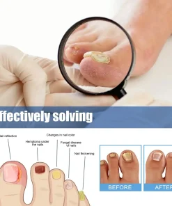 Acezozla® Fungus Nail Repair Patches