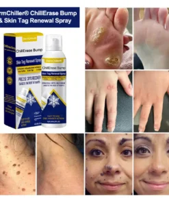 DermChiller® ChillErase Bump & Skin Tag Renewal Spray