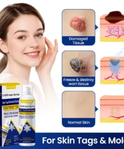 DermChiller® ChillErase Bump & Skin Tag Renewal Spray