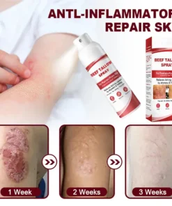 OUR+™ Beef Tallow Spray for Itchy, Flaky Psoriasis Skin