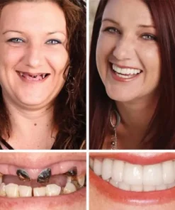 Rianmond™ Medical Full Denture with Strong Suctiond