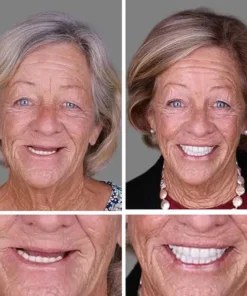 Rianmond™ Medical Full Denture with Strong Suctiond