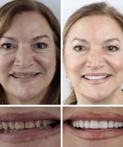 Rianmond™ Medical Full Denture with Strong Suctiond