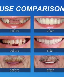 Rianmond™ Medical Full Denture with Strong Suctiond