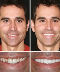 Rianmond™ Medical Full Denture with Strong Suctiond