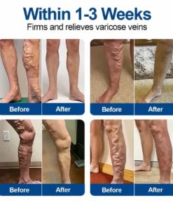 VERVEBEAD™ Vein Ease Microneedle Patch